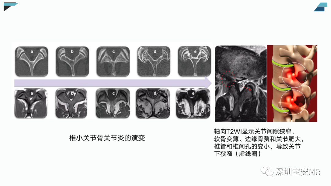 【PPT】椎小关节常见病变的影像表现-9
