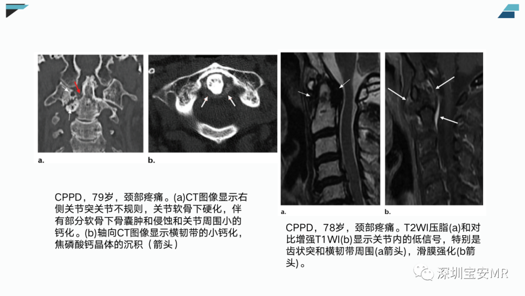 【PPT】椎小关节常见病变的影像表现-25