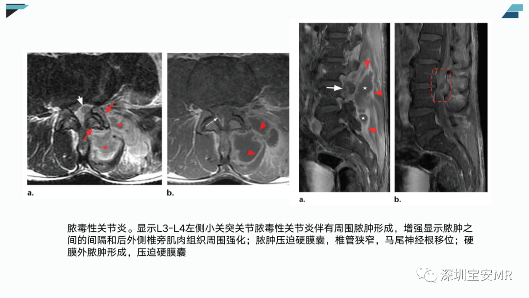 【PPT】椎小关节常见病变的影像表现-19