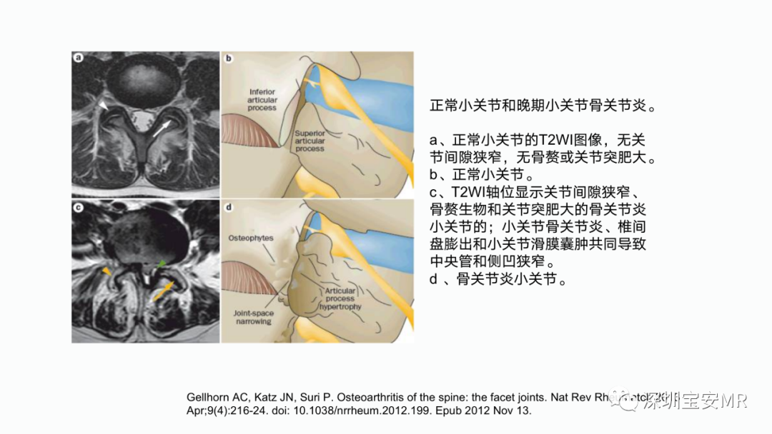 【PPT】椎小关节常见病变的影像表现-10