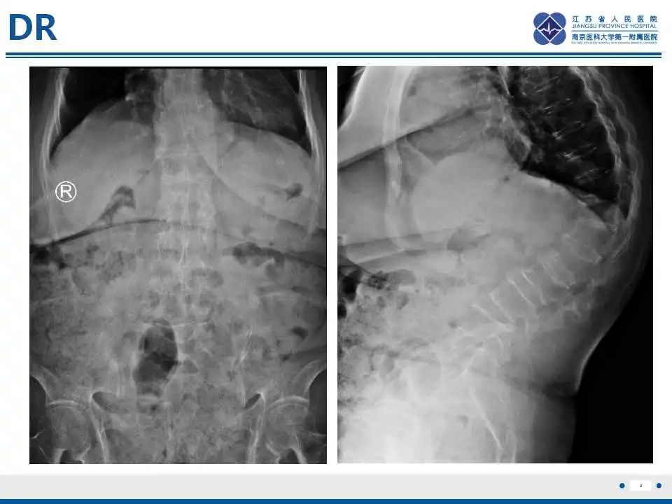 【PPT】虚拟去钙技术在骨髓水肿中的应用-3