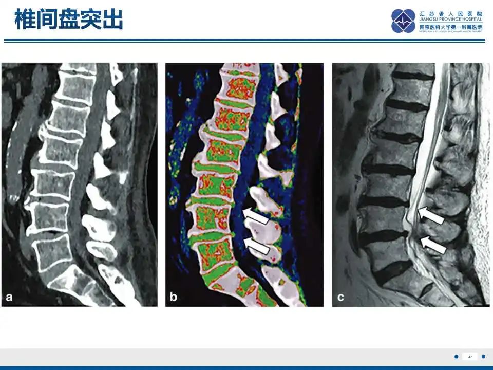 【PPT】虚拟去钙技术在骨髓水肿中的应用-28