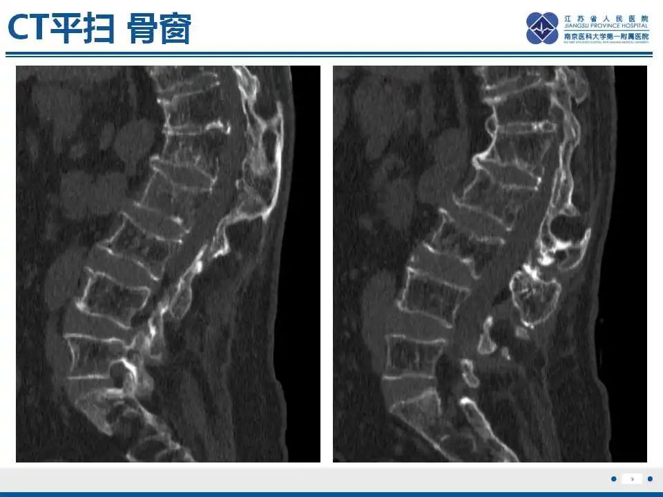 【PPT】虚拟去钙技术在骨髓水肿中的应用-4