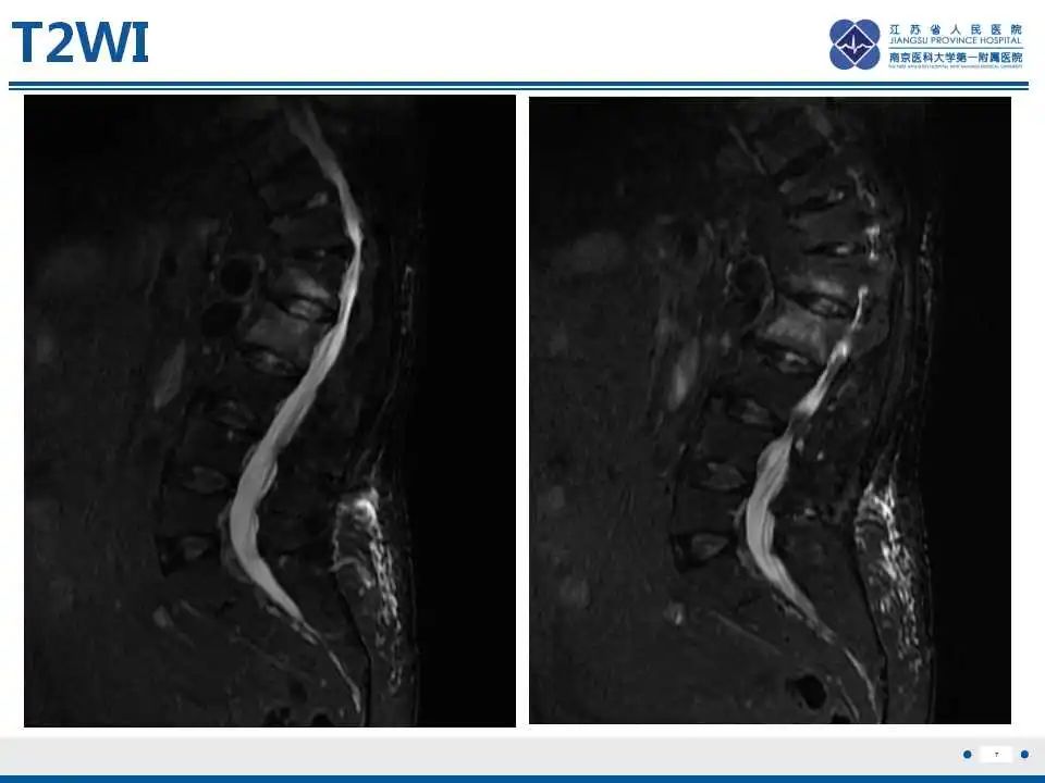【PPT】虚拟去钙技术在骨髓水肿中的应用-8