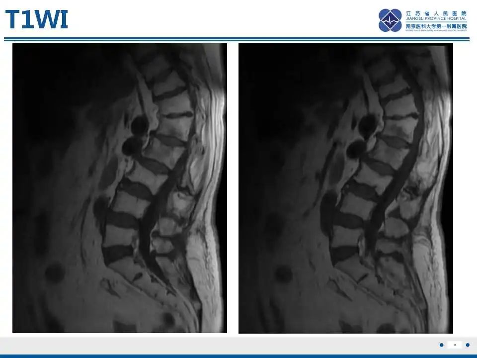 【PPT】虚拟去钙技术在骨髓水肿中的应用-7