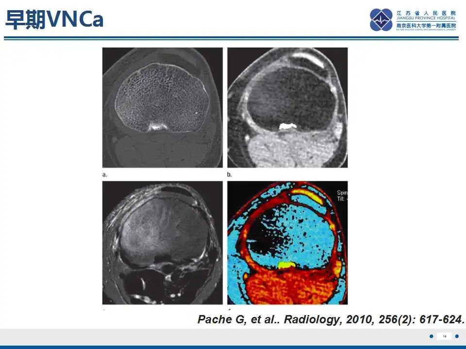 【PPT】虚拟去钙技术在骨髓水肿中的应用-17