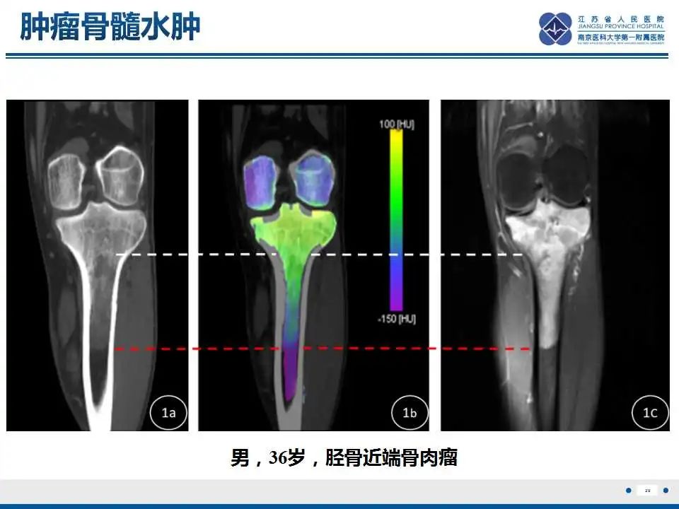 【PPT】虚拟去钙技术在骨髓水肿中的应用-30
