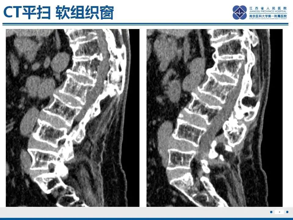 【PPT】虚拟去钙技术在骨髓水肿中的应用-5