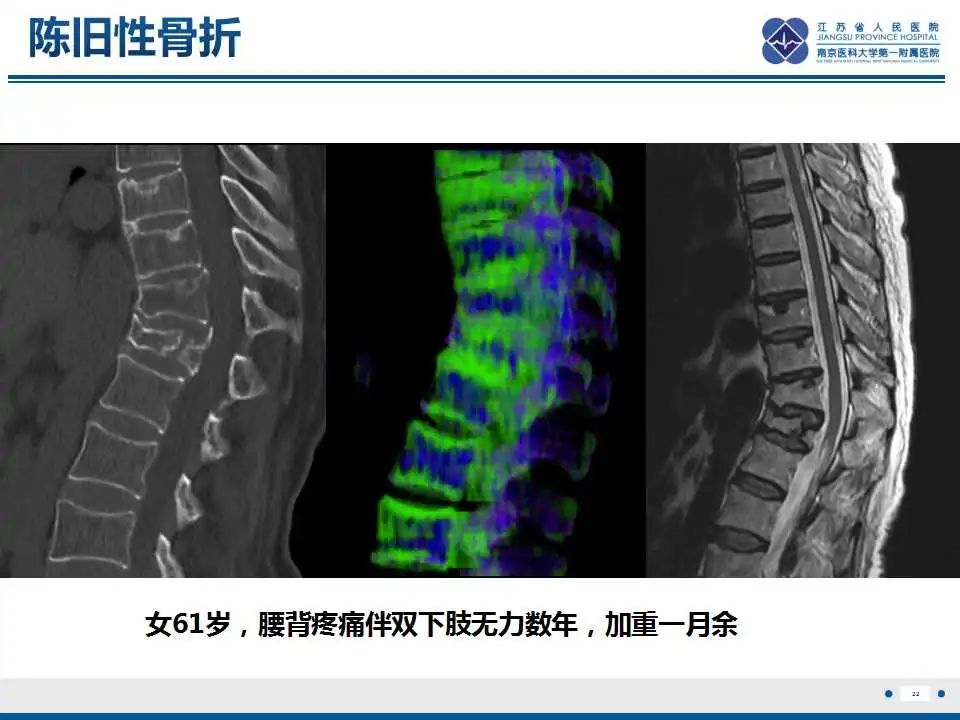 【PPT】虚拟去钙技术在骨髓水肿中的应用-23