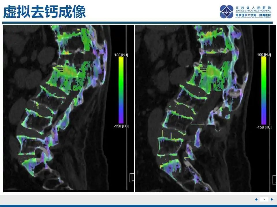 【PPT】虚拟去钙技术在骨髓水肿中的应用-6