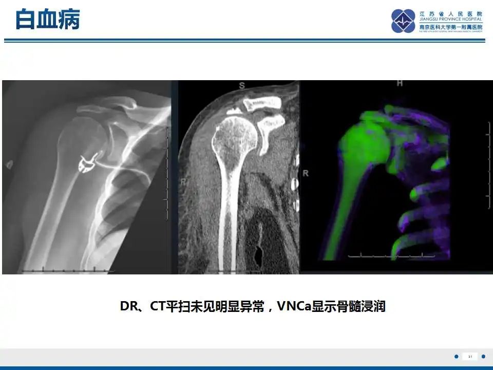 【PPT】虚拟去钙技术在骨髓水肿中的应用-32