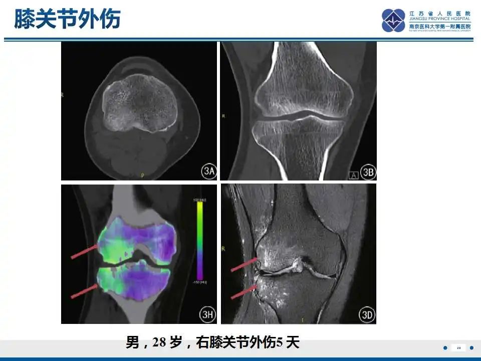 【PPT】虚拟去钙技术在骨髓水肿中的应用-29