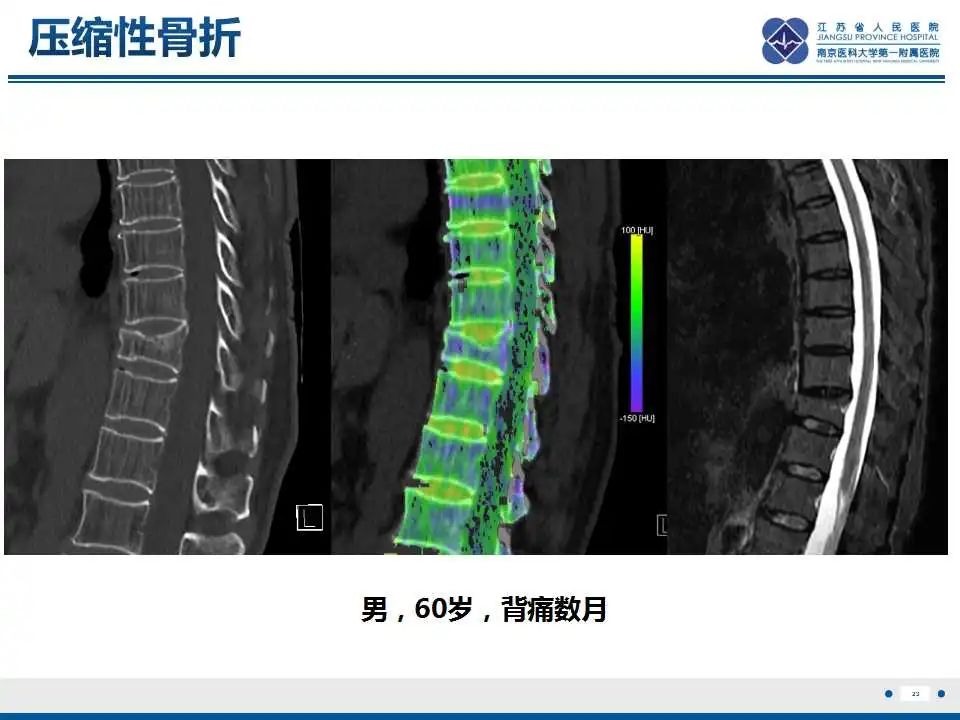 【PPT】虚拟去钙技术在骨髓水肿中的应用-24