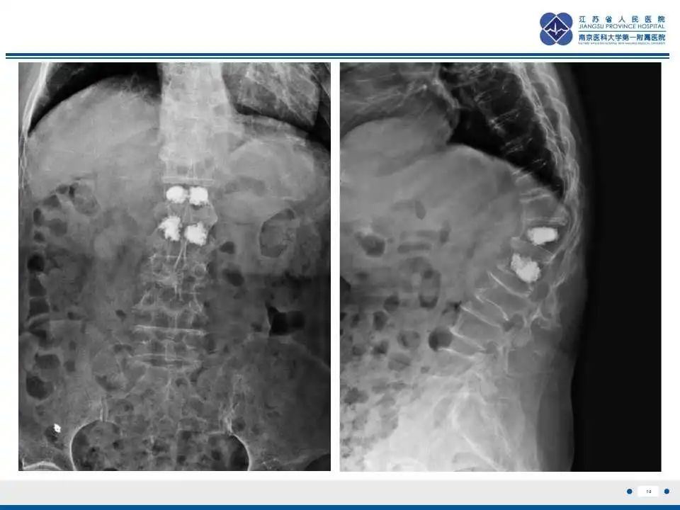 【PPT】虚拟去钙技术在骨髓水肿中的应用-11