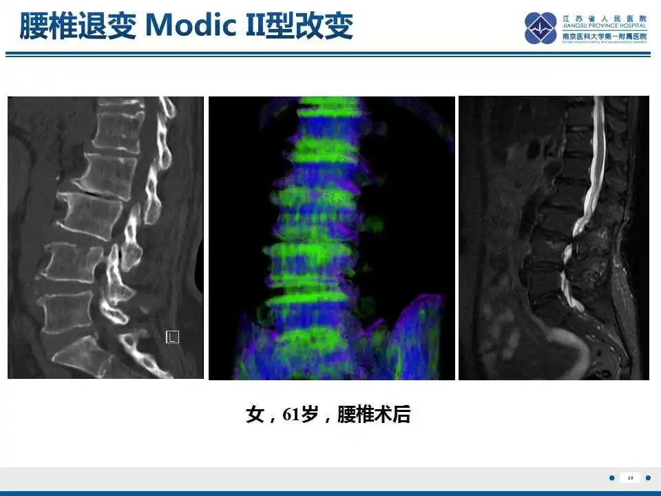 【PPT】虚拟去钙技术在骨髓水肿中的应用-26