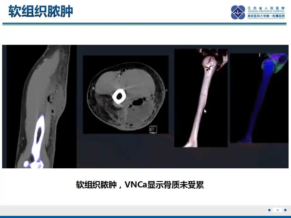 【PPT】虚拟去钙技术在骨髓水肿中的应用-31