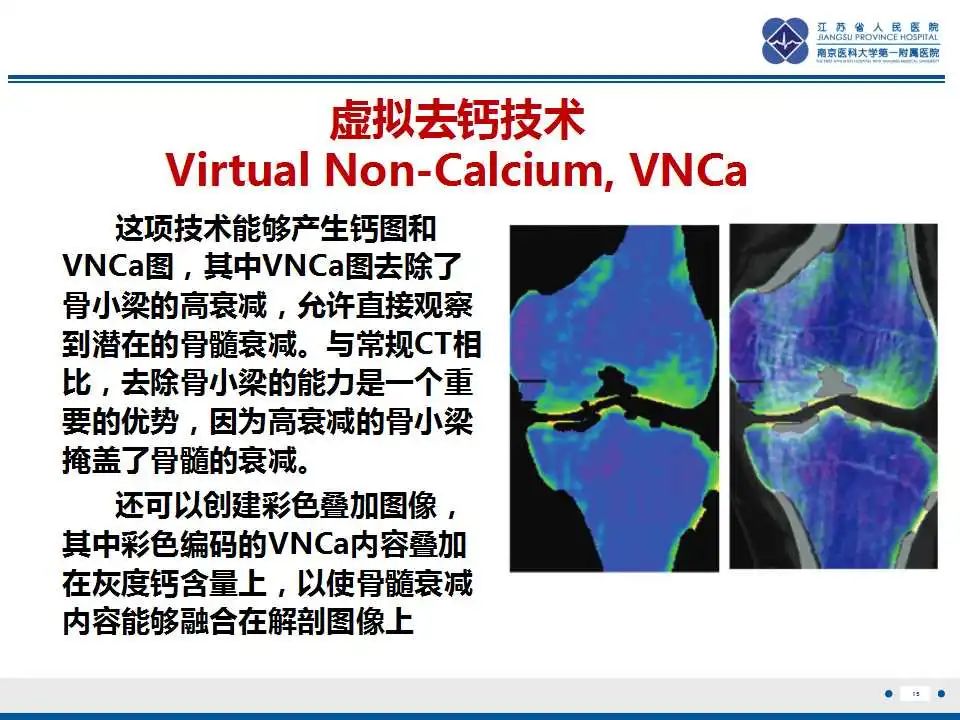 【PPT】虚拟去钙技术在骨髓水肿中的应用-16