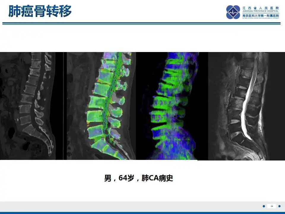 【PPT】虚拟去钙技术在骨髓水肿中的应用-25