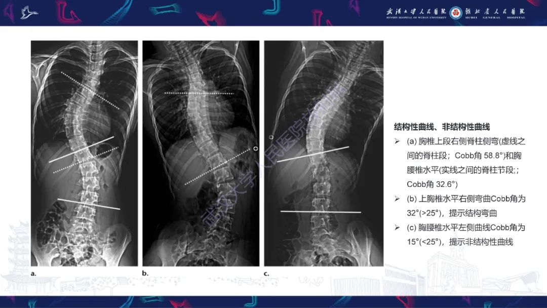 【PPT】脊柱侧弯影像学评估-15