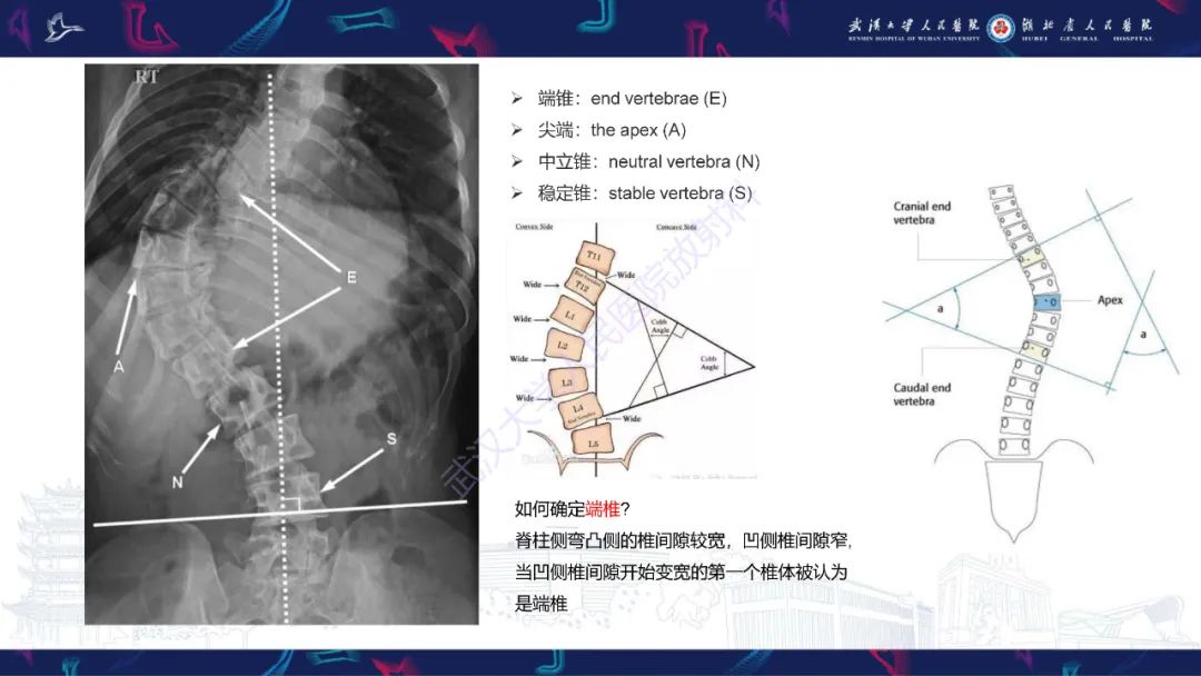 【PPT】脊柱侧弯影像学评估-10