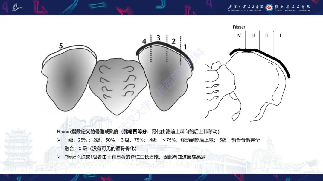 【PPT】脊柱侧弯影像学评估-28