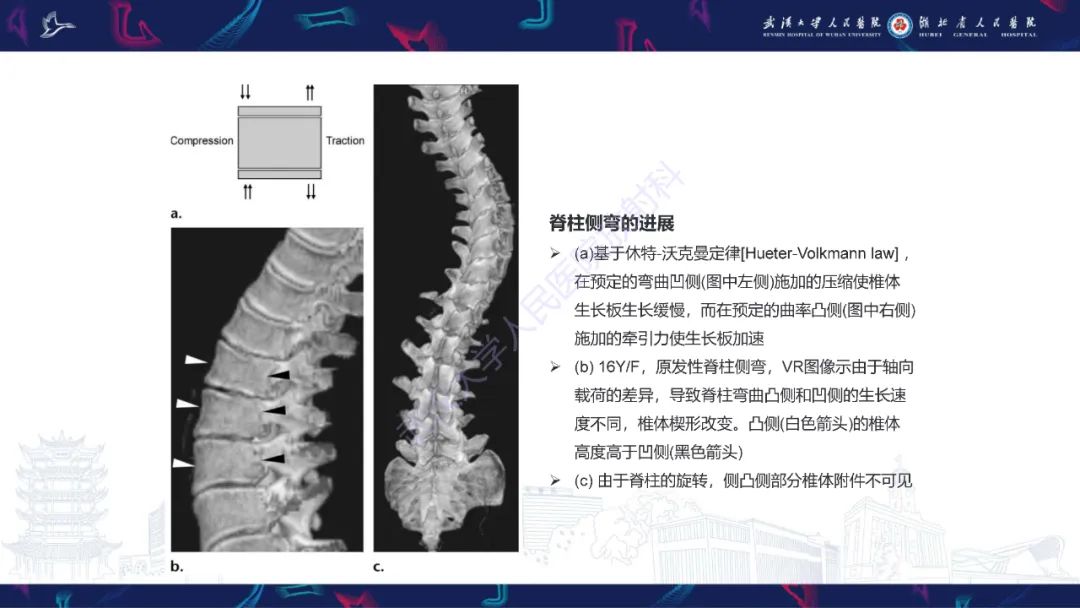 【PPT】脊柱侧弯影像学评估-6
