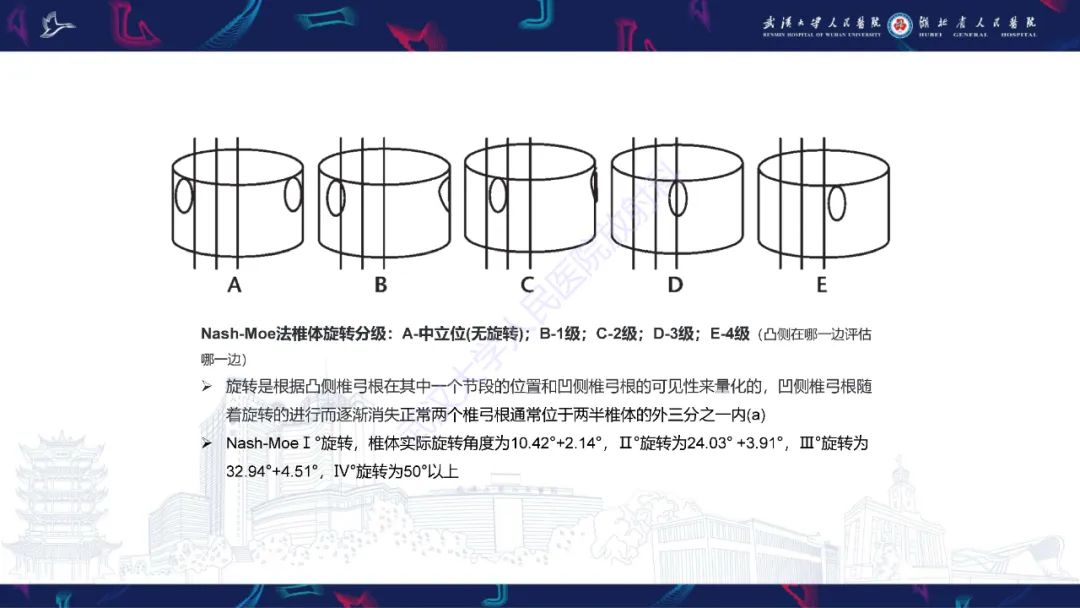 【PPT】脊柱侧弯影像学评估-20