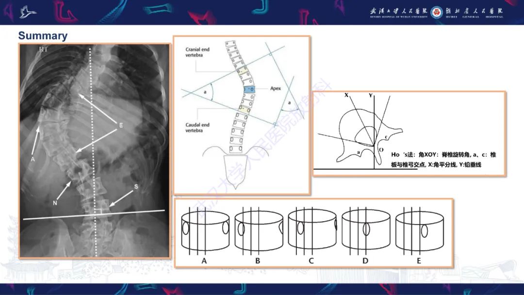 【PPT】脊柱侧弯影像学评估-41