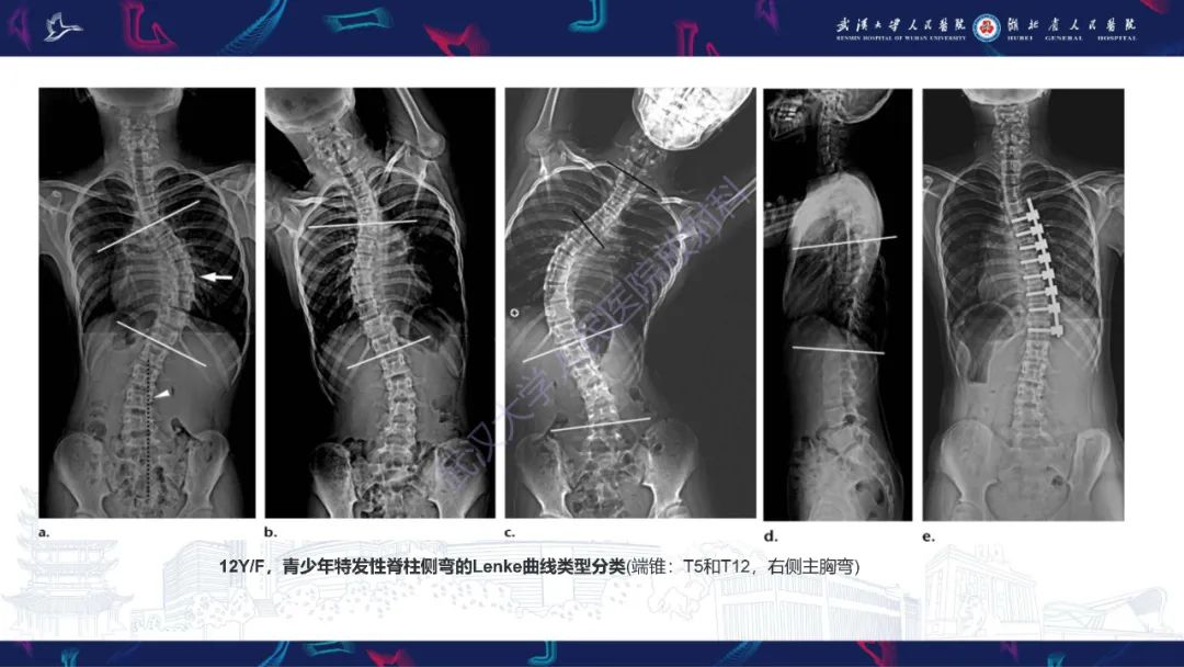 【PPT】脊柱侧弯影像学评估-33