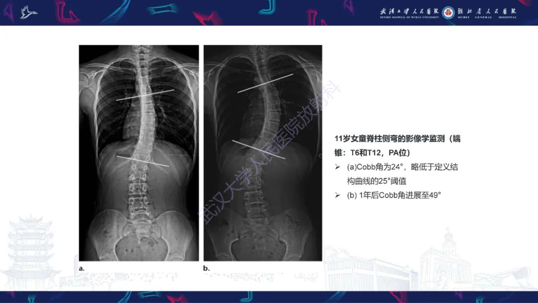 【PPT】脊柱侧弯影像学评估-30