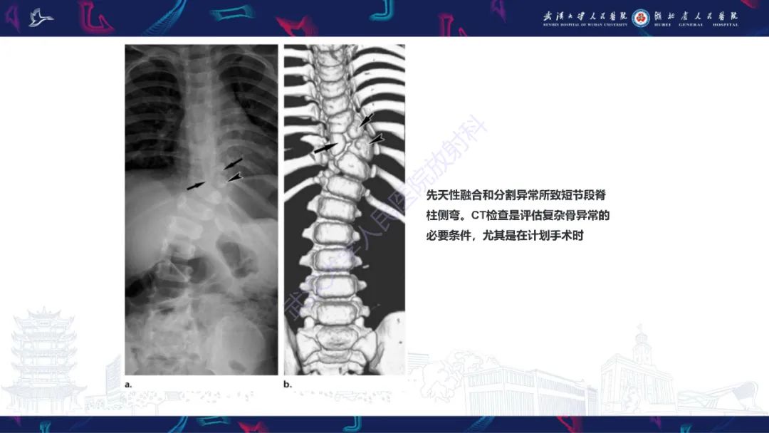 【PPT】脊柱侧弯影像学评估-37
