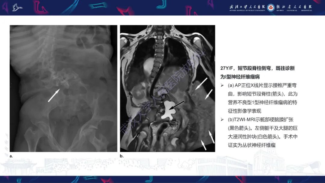 【PPT】脊柱侧弯影像学评估-36