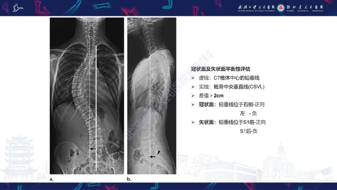 【PPT】脊柱侧弯影像学评估-17