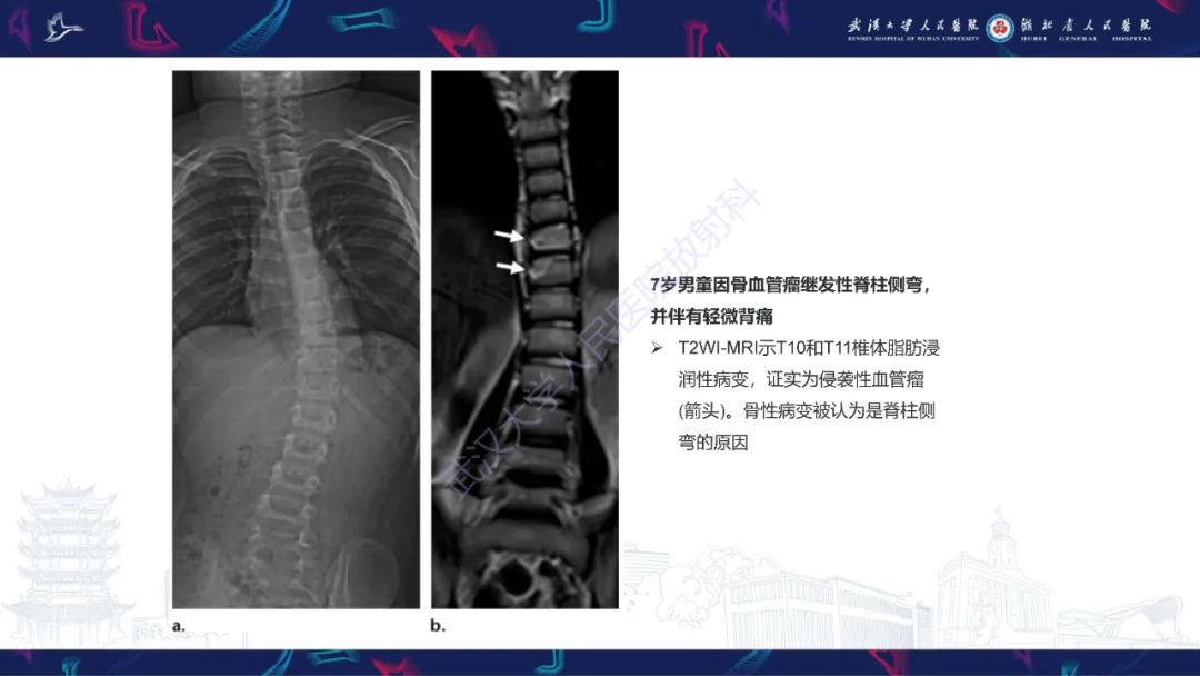【PPT】脊柱侧弯影像学评估-35