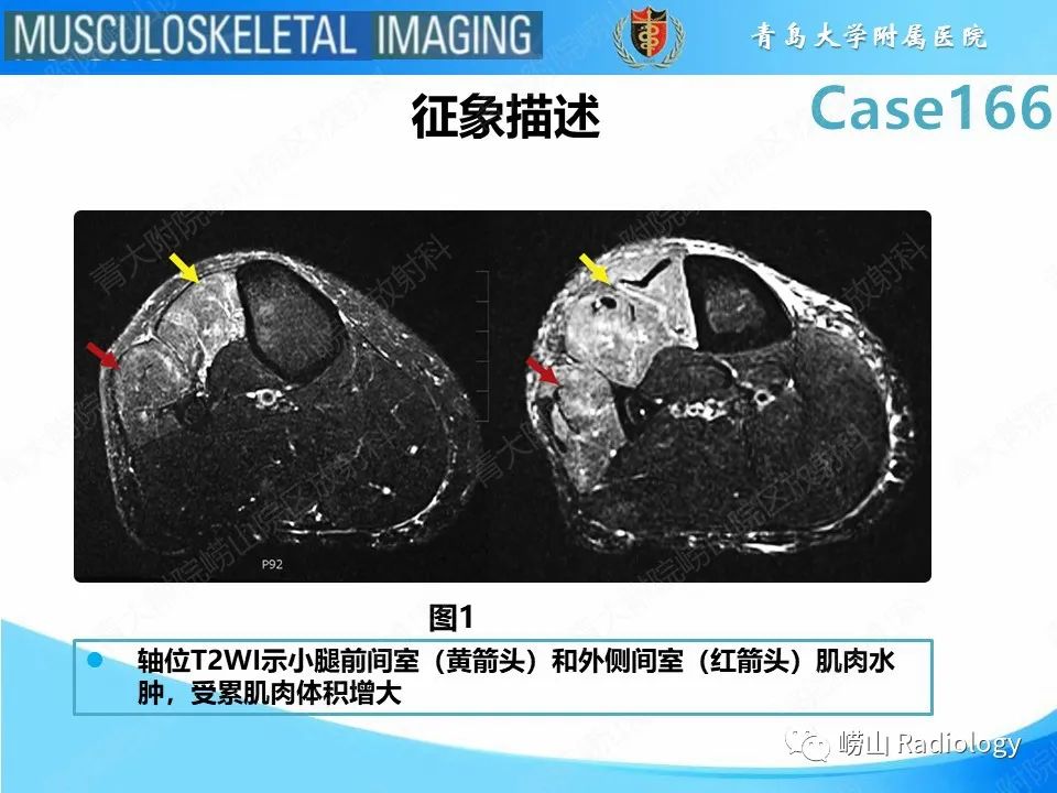 【PPT】骨筋膜室综合征-11
