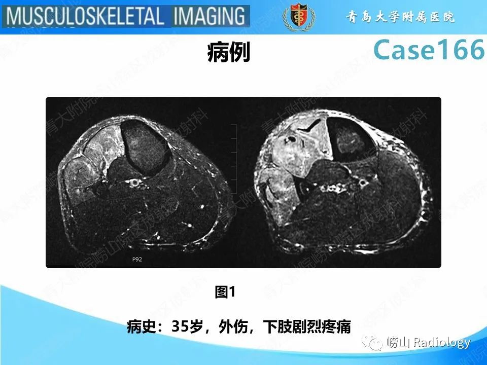 【PPT】骨筋膜室综合征-2