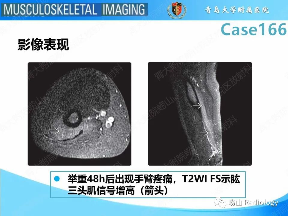 【PPT】骨筋膜室综合征-24
