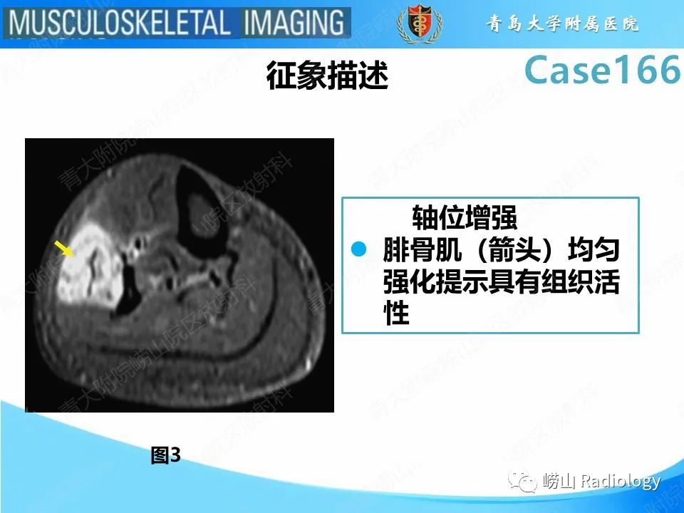 【PPT】骨筋膜室综合征-13