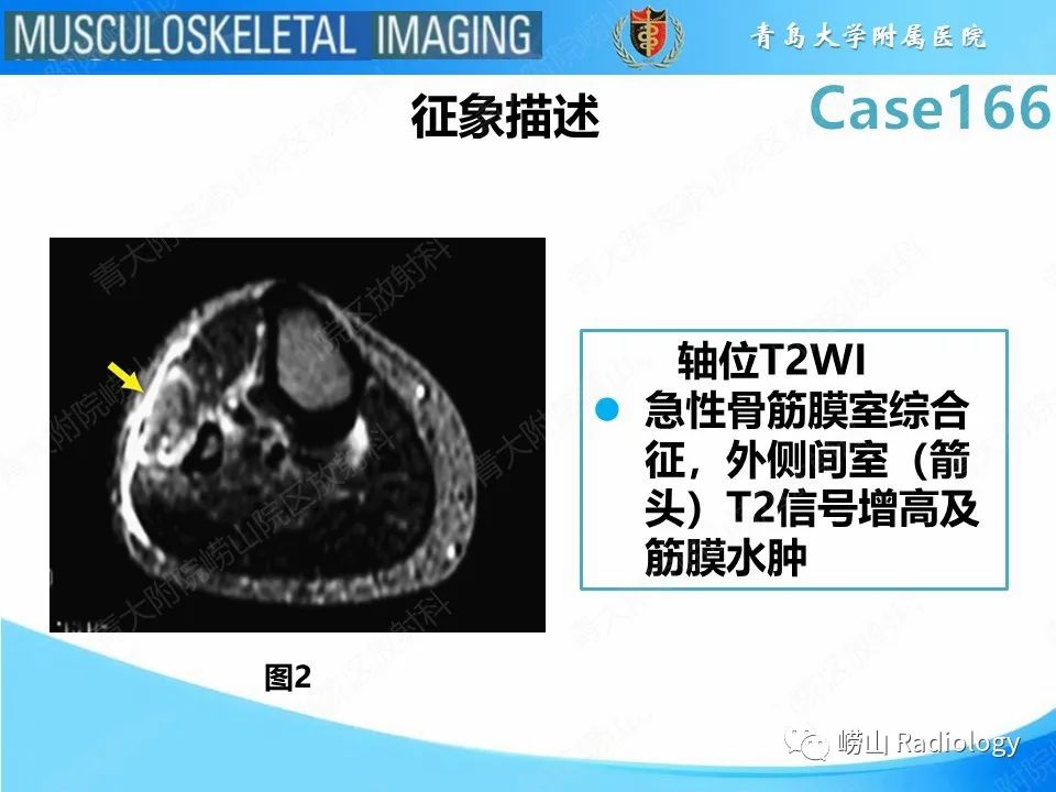 【PPT】骨筋膜室综合征-12