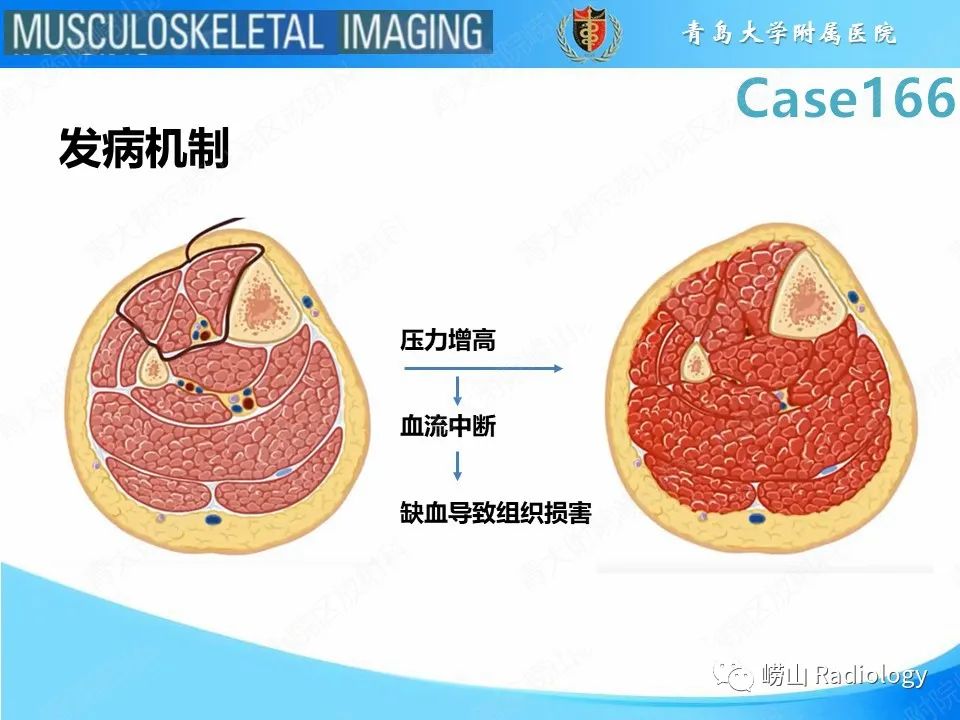 【PPT】骨筋膜室综合征-16