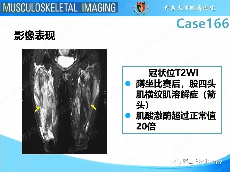 【PPT】骨筋膜室综合征-26