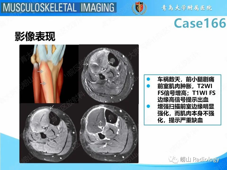 【PPT】骨筋膜室综合征-20