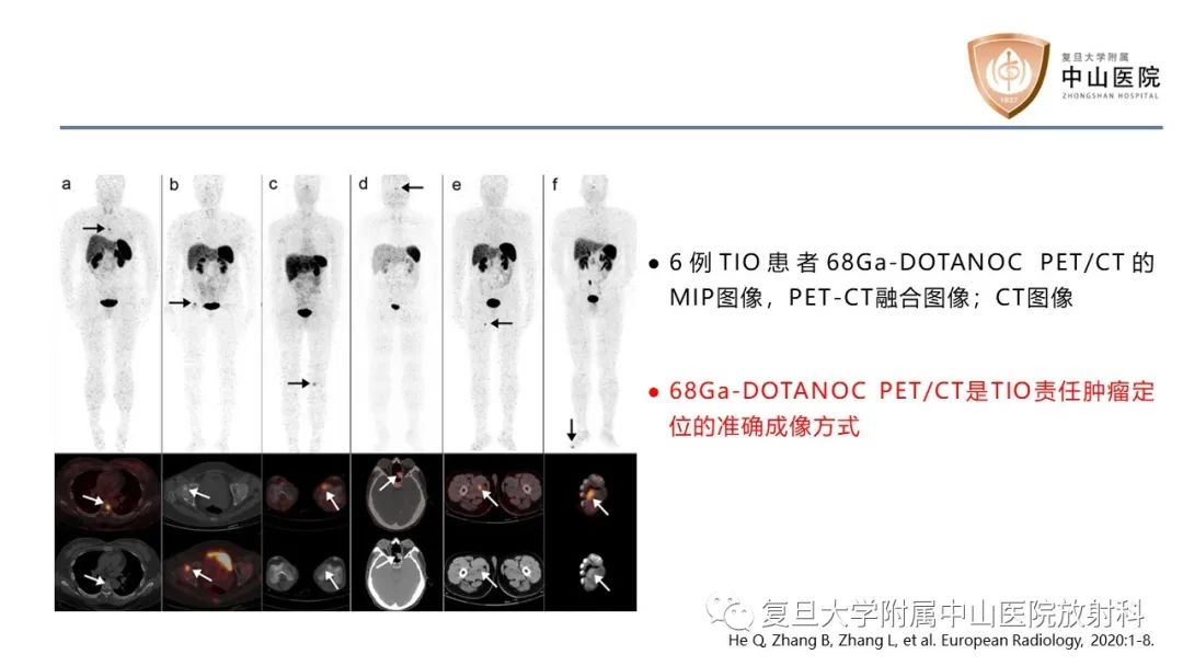 【病例】肿瘤相关性骨软化症1例X线CT及MR/PET-CT-22