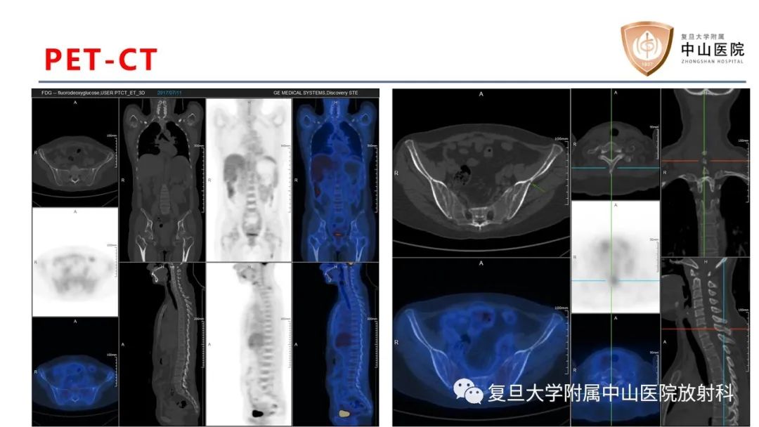 【病例】肿瘤相关性骨软化症1例X线CT及MR/PET-CT-9