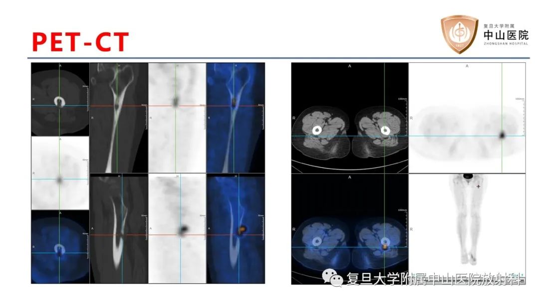 【病例】肿瘤相关性骨软化症1例X线CT及MR/PET-CT-10