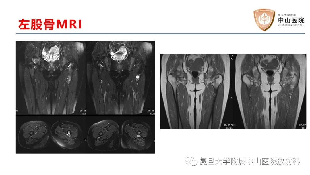 【病例】肿瘤相关性骨软化症1例X线CT及MR/PET-CT-7