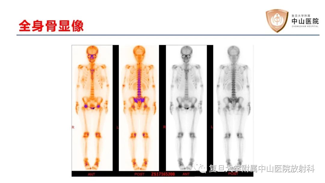 【病例】肿瘤相关性骨软化症1例X线CT及MR/PET-CT-8