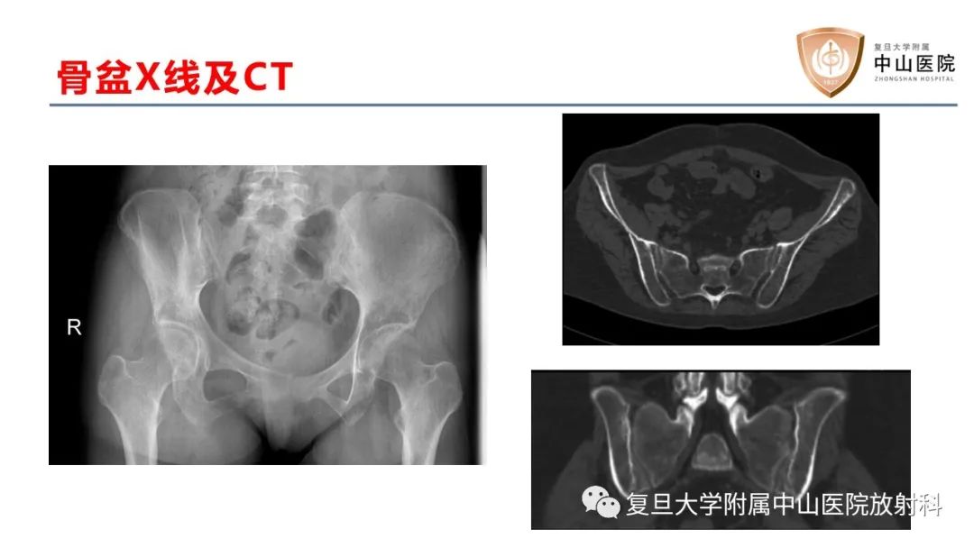 【病例】肿瘤相关性骨软化症1例X线CT及MR/PET-CT-5