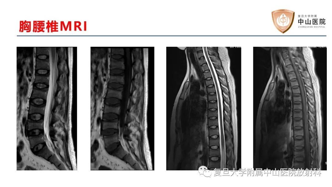 【病例】肿瘤相关性骨软化症1例X线CT及MR/PET-CT-6