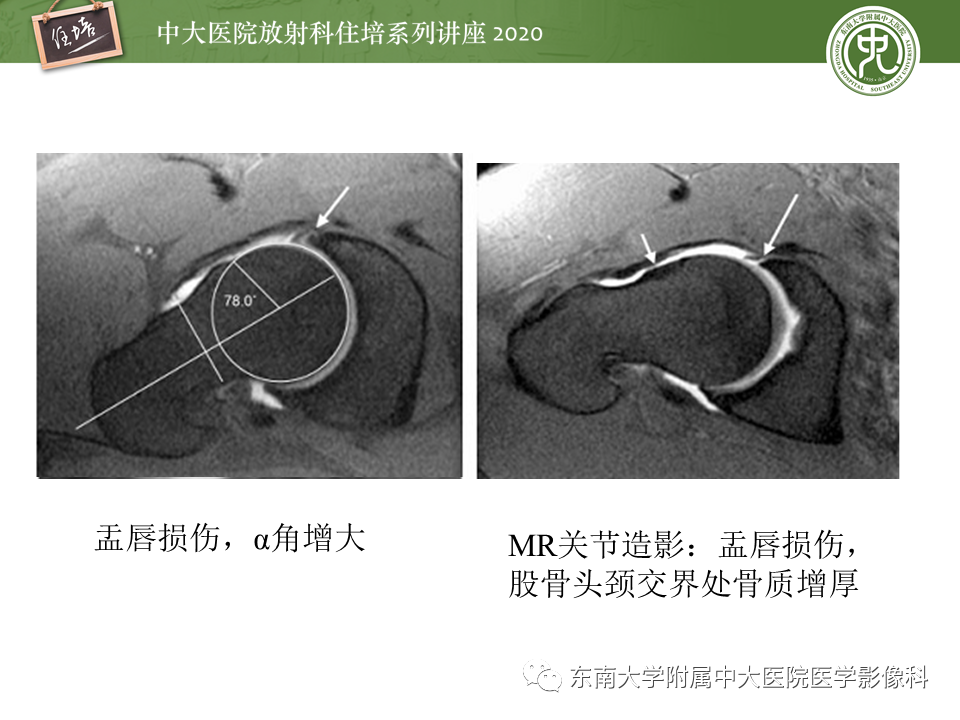 【PPT】常见撞击综合征的影像诊断-35